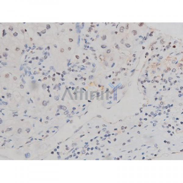 Phospho-Tau (Thr205)[Thr522] Antibody - AF3150 at 1/200 staining Human kidney cancer tissue sections by IHC-P.